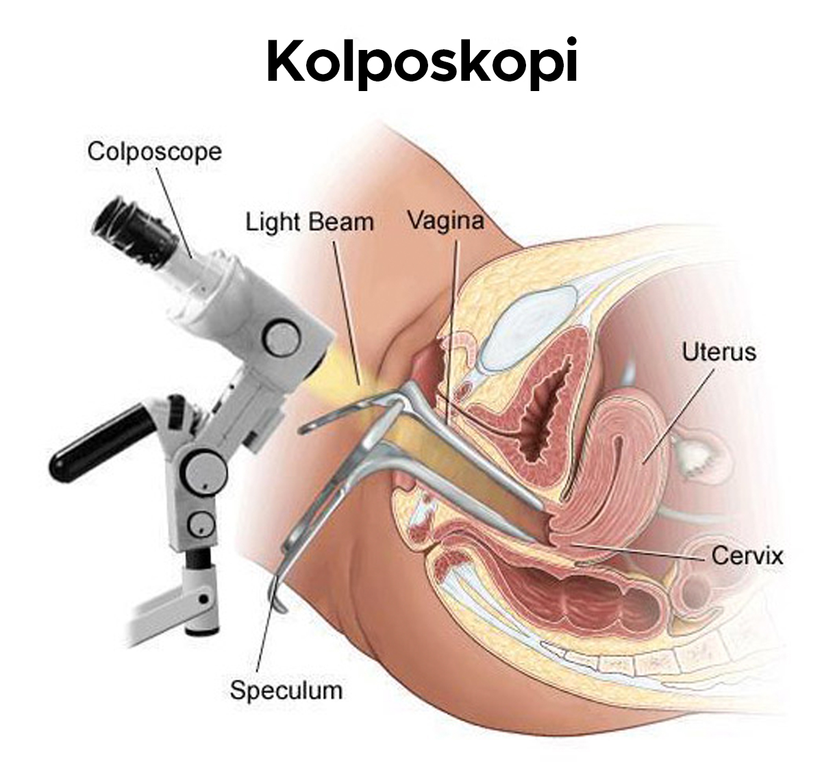 Kolposkopi Nedir İşlem, Hazırlık ve Sonrası Bilgiler