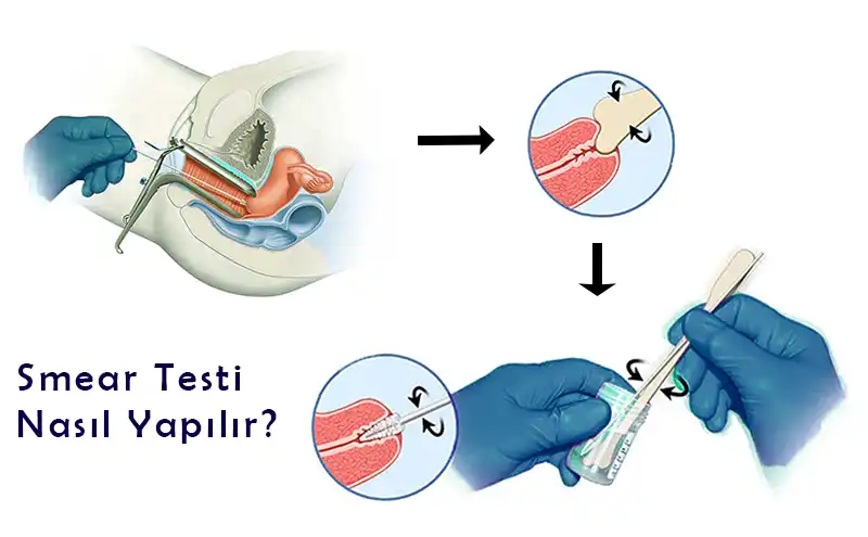 Smear Testi Nasıl Yapılır? (Simir Testi Nasıl Yapılır)